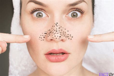 Jan 27, 2017 While most videos show pops executed with a comedone extractor, the latest viral sensation is a close-up look at how pore strips work. . Extreme blackhead popping